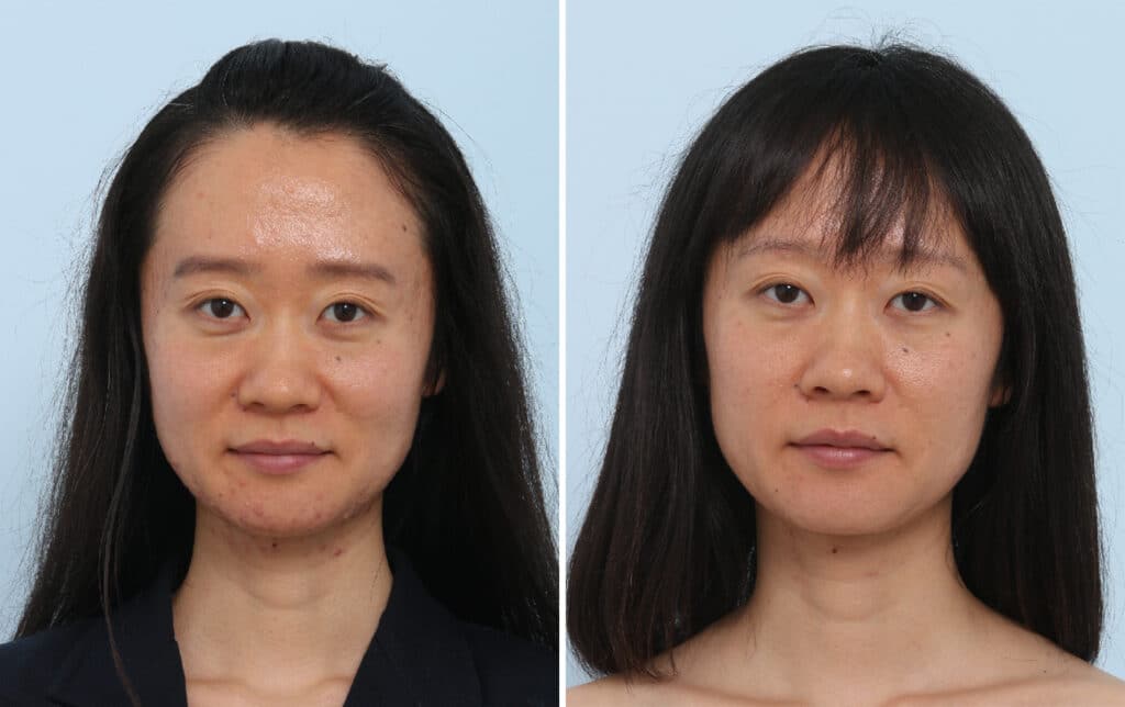 120853 Chemical Peels 1