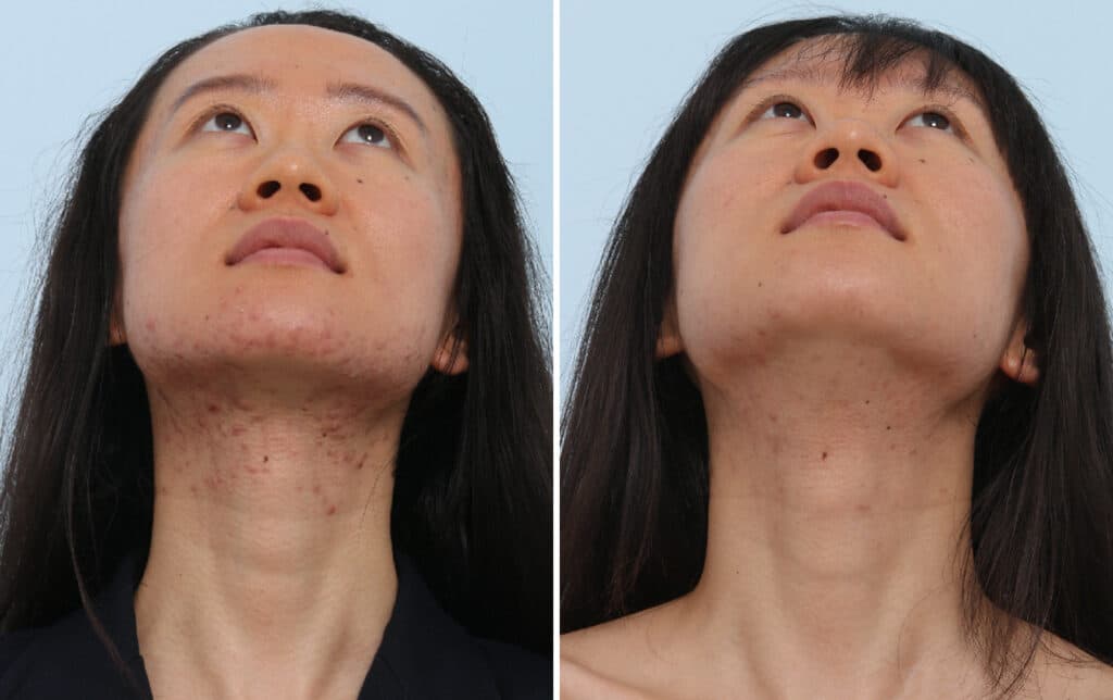 120853 Chemical Peels 2