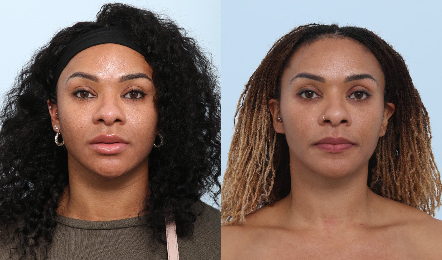 Before and After Image: Chemical Peels Before and After Photos in Houston, TX, Patient 17680 - front