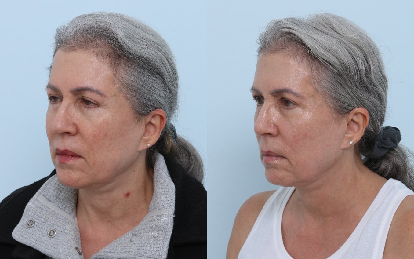 Before and After Image: Ulthera Lift Before and After Photos in Houston, TX, Patient 17684 - left-front-oblique