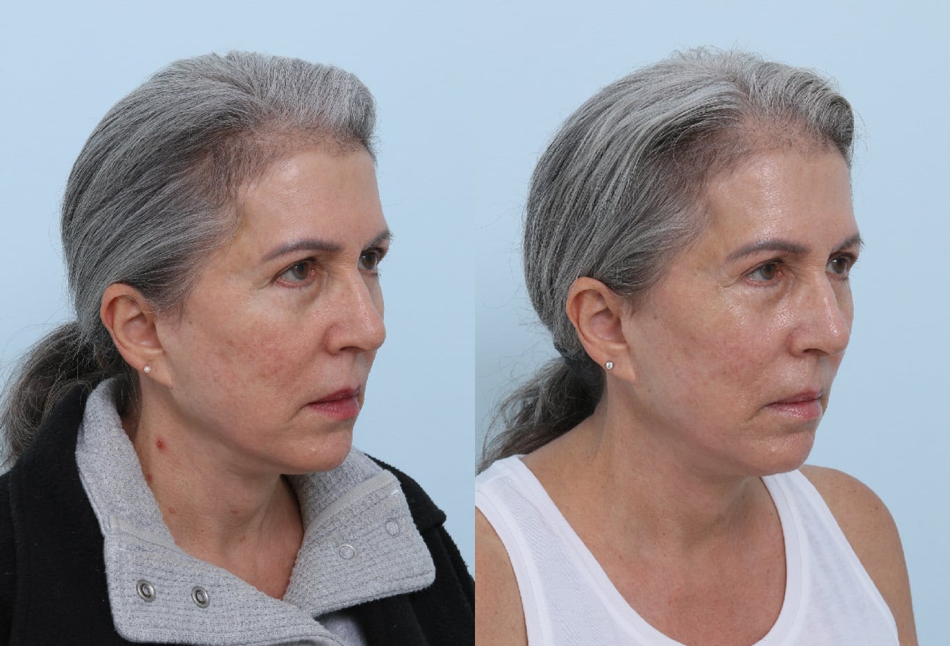 Before and After Image: Ulthera Lift Before and After Photos in Houston, TX, Patient 17684 - right-front-oblique