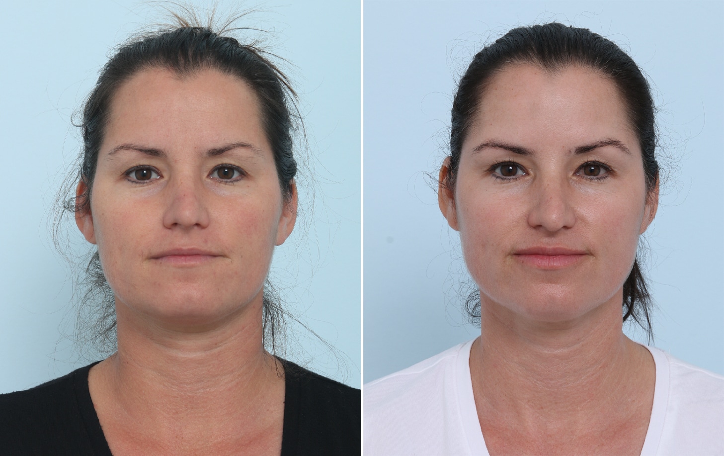 Before and After Image: Fraxel Laser Before and After Photos in Houston, TX, Patient 17806 - front