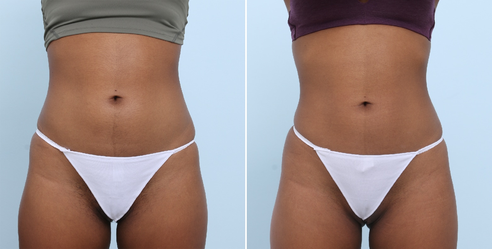 Before and After Image: CoolSculpting Before and After Photos in Houston, TX, Patient 17818 - front