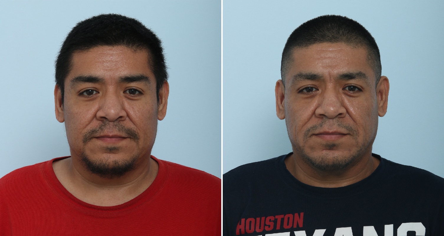 Before and After Image: Fraxel Laser Before and After Photos in Houston, TX, Patient 17810 - front