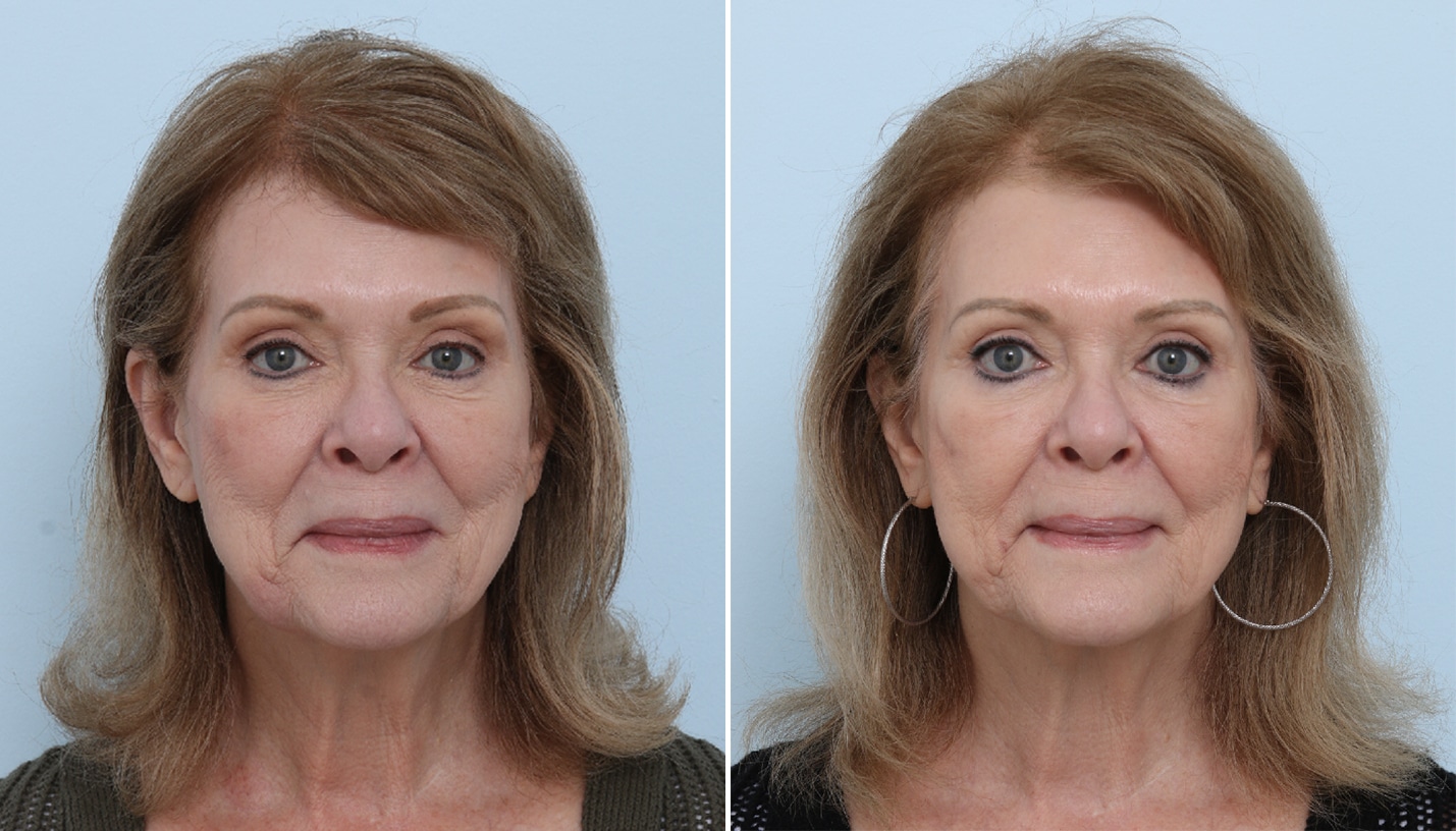 Before and After Image: SkinPen® Microneedling with Growth Factors Before and After Photos in Houston, TX, Patient - front