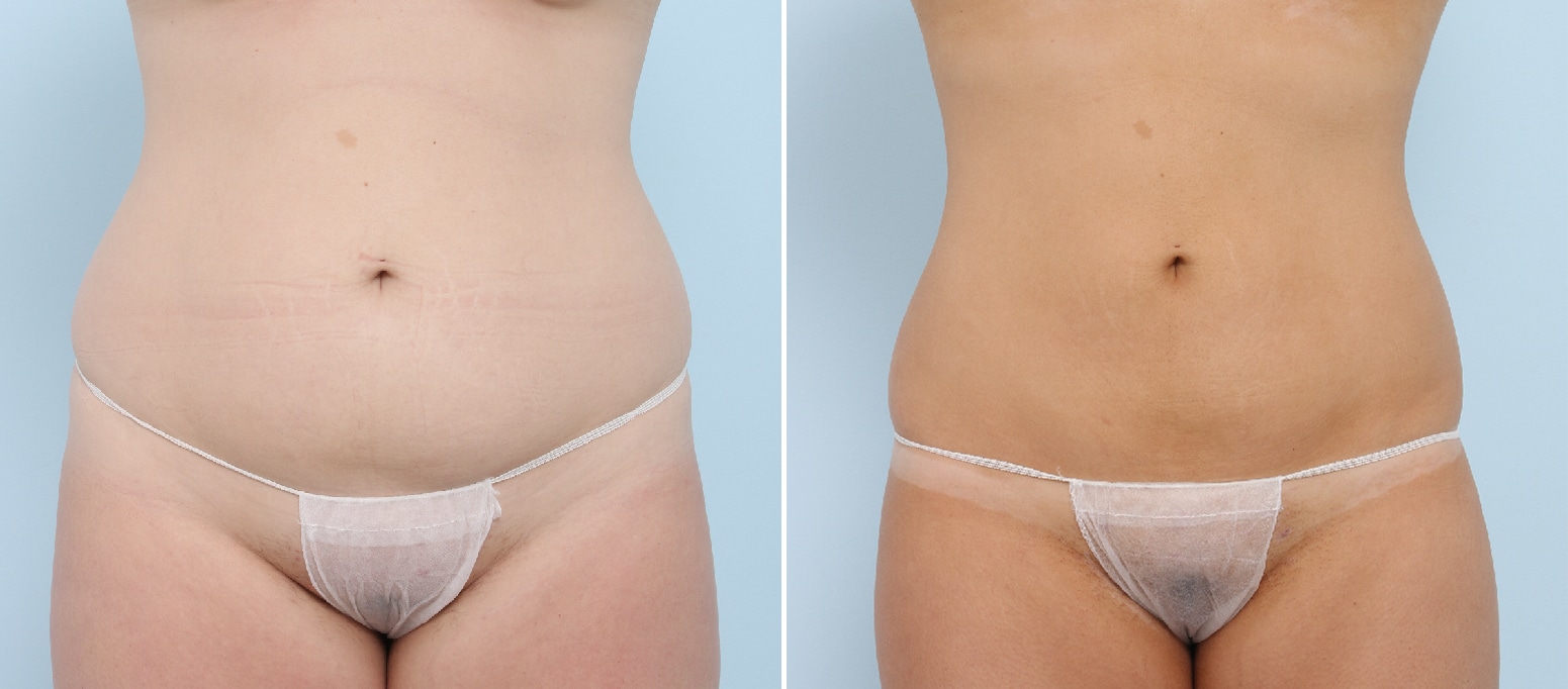 Before and After Image: CoolSculpting Before and After Photos in Houston, TX, Patient 17839 - front