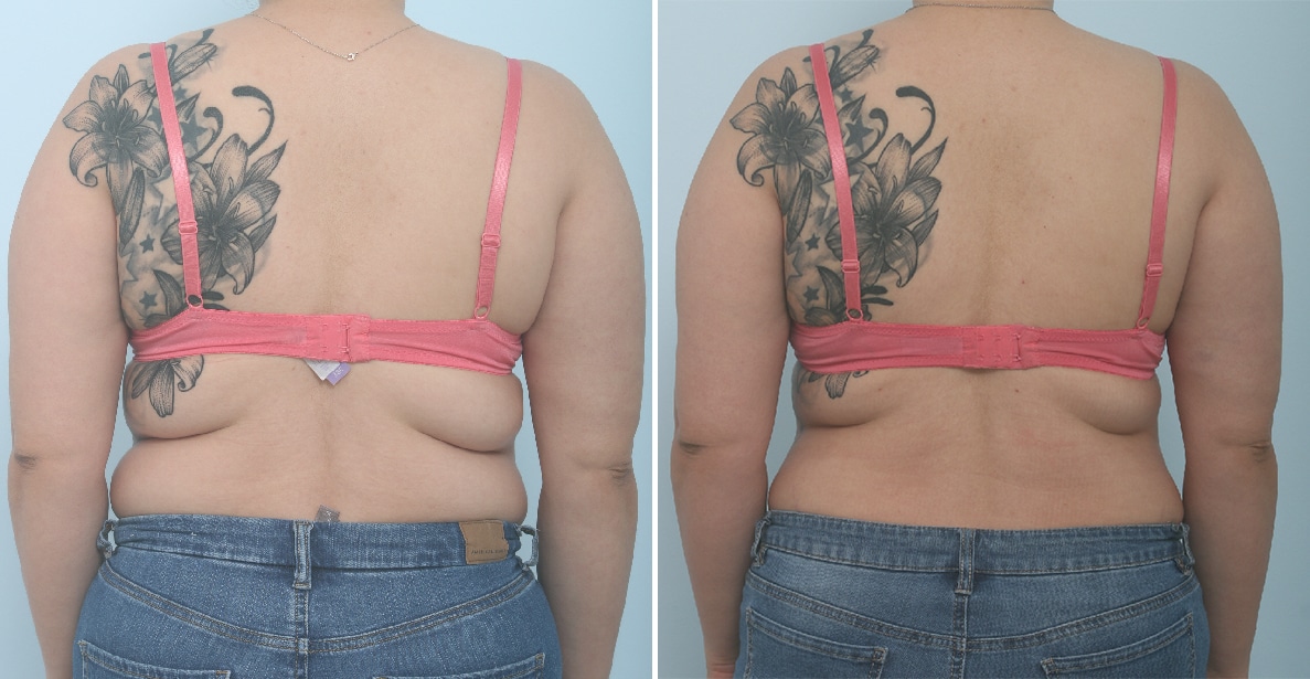 Before and After Image: CoolSculpting Before and After Photos in Houston, TX, Patient 17844 - back